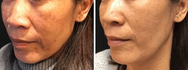 Melasma-Yag-Laser-60200-62yo-Asian-Female-BeforeandAfter2Treatments-LeftCheek-CROP